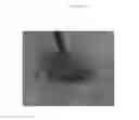 Fig. 08 - Emulsions or microemulsions for use in endoscopic mucosal resectioning and/or endoscopic submucosal dissection