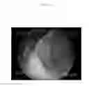 Fig. 16 - Emulsions or microemulsions for use in endoscopic mucosal resectioning and/or endoscopic submucosal dissection