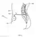 Fig. 03 - Determining catheter status