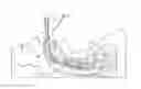 Fig. 01 - TRACHEAL TUBES AND METHODS RELATED THERETO