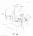 Fig. 72 - Intramold headgear