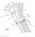 Fig. 03 - CATHETER CLIP