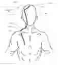 Fig. 01 - Ventriculoperitoneal shunt with pressure responsive element