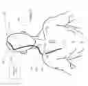 Fig. 07 - Ventriculoperitoneal shunt with pressure responsive element