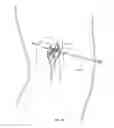 Fig. 10 - METHODS AND DEVICES TO MODULATE THE AUTONOMIC NERVOUS SYSTEM VIA THE CAROTID BODY OR CAROTID SINUS