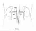 Fig. 11 - METHODS AND DEVICES TO MODULATE THE AUTONOMIC NERVOUS SYSTEM VIA THE CAROTID BODY OR CAROTID SINUS