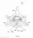 Fig. 18 - METHODS AND DEVICES TO MODULATE THE AUTONOMIC NERVOUS SYSTEM VIA THE CAROTID BODY OR CAROTID SINUS
