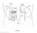 Fig. 19 - METHODS AND DEVICES TO MODULATE THE AUTONOMIC NERVOUS SYSTEM VIA THE CAROTID BODY OR CAROTID SINUS