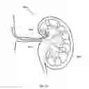 Fig. 22 - METHODS AND DEVICES TO MODULATE THE AUTONOMIC NERVOUS SYSTEM VIA THE CAROTID BODY OR CAROTID SINUS