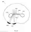 Fig. 23 - METHODS AND DEVICES TO MODULATE THE AUTONOMIC NERVOUS SYSTEM VIA THE CAROTID BODY OR CAROTID SINUS