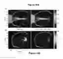 Fig. 11 - PLANNING SYSTEM FOR TARGETING TISSUE STRUCTURES WITH ULTRASOUND