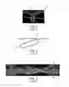 Fig. 02 - Method Of Making Nonwoven Material Having Discrete Three-Dimensional Deformations With Wide Base Openings That are Tip Bonded to Additional Layer