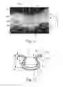 Fig. 07 - Method Of Making Nonwoven Material Having Discrete Three-Dimensional Deformations With Wide Base Openings That are Tip Bonded to Additional Layer