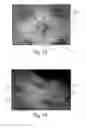 Fig. 12 - Method Of Making Nonwoven Material Having Discrete Three-Dimensional Deformations With Wide Base Openings That are Tip Bonded to Additional Layer