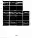 Fig. 06 - Effective delivery of large genes by dual AAV vectors