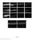 Fig. 07 - Effective delivery of large genes by dual AAV vectors