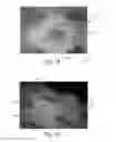 Fig. 12 - Method of making nonwoven material having discrete three-dimensional deformations with wide base openings