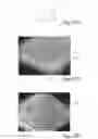 Fig. 17 - Method of making nonwoven material having discrete three-dimensional deformations with wide base openings