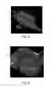 Fig. 05 - Apparatus having forming members with surface texture for making nonwoven material having discrete three-dimensional deformations with wide base openings
