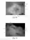 Fig. 12 - Apparatus having forming members with surface texture for making nonwoven material having discrete three-dimensional deformations with wide base openings