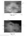 Fig. 12 - Method Of Making Nonwoven Material Having Discrete Three-Dimensional Deformations With Wide Base Openings Using Forming Members With Surface Texture