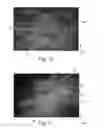Fig. 11 - Nonwoven material having discrete three-dimensional deformations that are configured to collapse in a controlled manner