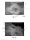 Fig. 12 - Nonwoven material having discrete three-dimensional deformations that are configured to collapse in a controlled manner