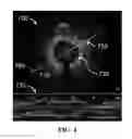 Fig. 05 - Apparatus and methods for identifying and evaluating bright spot indications observed through optical coherence tomography