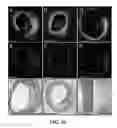 Fig. 19 - Apparatus and methods for identifying and evaluating bright spot indications observed through optical coherence tomography