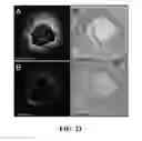 Fig. 20 - Apparatus and methods for identifying and evaluating bright spot indications observed through optical coherence tomography