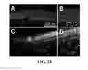 Fig. 23 - Apparatus and methods for identifying and evaluating bright spot indications observed through optical coherence tomography