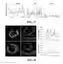 Fig. 25 - Apparatus and methods for identifying and evaluating bright spot indications observed through optical coherence tomography