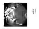 Fig. 03 - Metal artifacts reduction in cone beam reconstruction