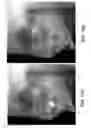 Fig. 12 - Metal artifacts reduction in cone beam reconstruction