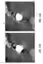 Fig. 13 - Metal artifacts reduction in cone beam reconstruction