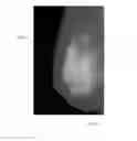 Fig. 10 - High dynamic range mammography using a restricted dynamic range FFDM