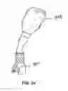 Fig. 15 - Tissue retractor and method of use