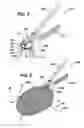 Fig. 04 - Method and means to attach anchor suture onto mesh implants