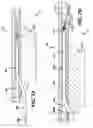 Fig. 09 - Catheter systems and methods for re-entry in body vessels with chronic total occlusion