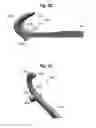 Fig. 15 - Soft tissue cutting device and methods of use