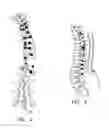 Fig. 03 - System and method for aligning vertebrae in the amelioration of aberrant spinal column deviation conditions