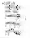 Fig. 06 - System and method for aligning vertebrae in the amelioration of aberrant spinal column deviation conditions
