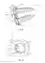 Fig. 06 - SURGICAL IMPLANT SYSTEM AND METHOD
