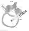 Fig. 19 - Process for introducing a stabilizing element into a vertebral element