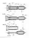 Fig. 34 - Process for introducing a stabilizing element into a vertebral element