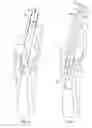 Fig. 05 - Percutaneous fixator and method of insertion