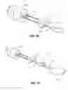 Fig. 03 - Implant retaining loop and guide wire extension