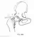 Fig. 13 - Medical ablation system and method of use