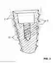 Fig. 04 - CONDENSING SKELETAL IMPLANT THAT FACILITATE INSERTIONS