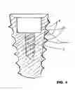 Fig. 05 - CONDENSING SKELETAL IMPLANT THAT FACILITATE INSERTIONS